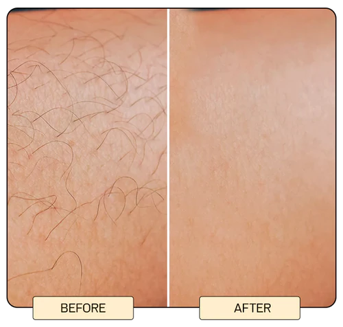 IPL Hair Removal Devices