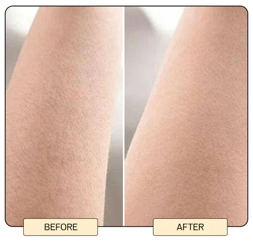 IPL Hair Removal Devices